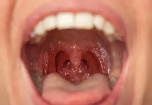 Bacterial throat infection treatment