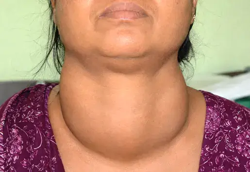 Diffuse Goiter