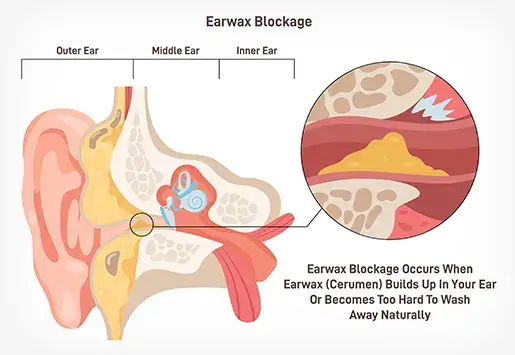 Ear pressure and blockage thumb