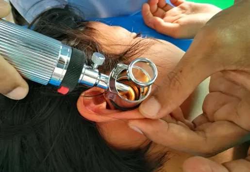 Eardrum Perforation