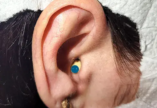 Foreign body in the ear  thumb