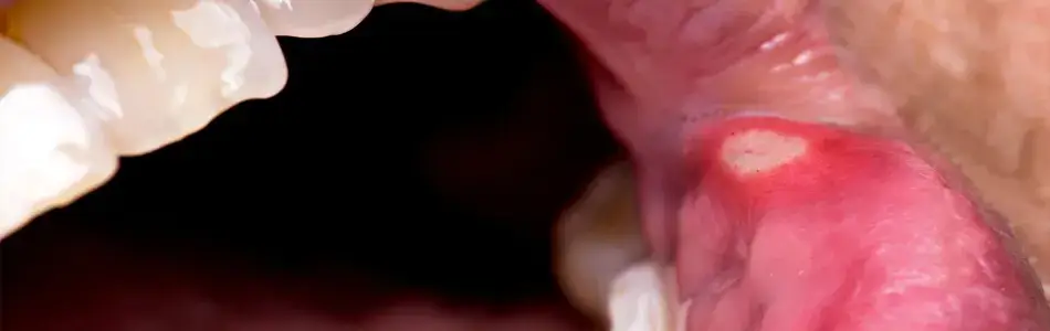 মুখের আলসারের প্রধান কারণ সমূহ