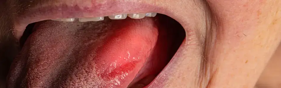 মুখের আলসারের সাধারণ লক্ষণসমূহ